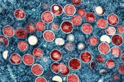 Primeiro caso de variante perigosa da Mpox fora da África é registrado na Suécia